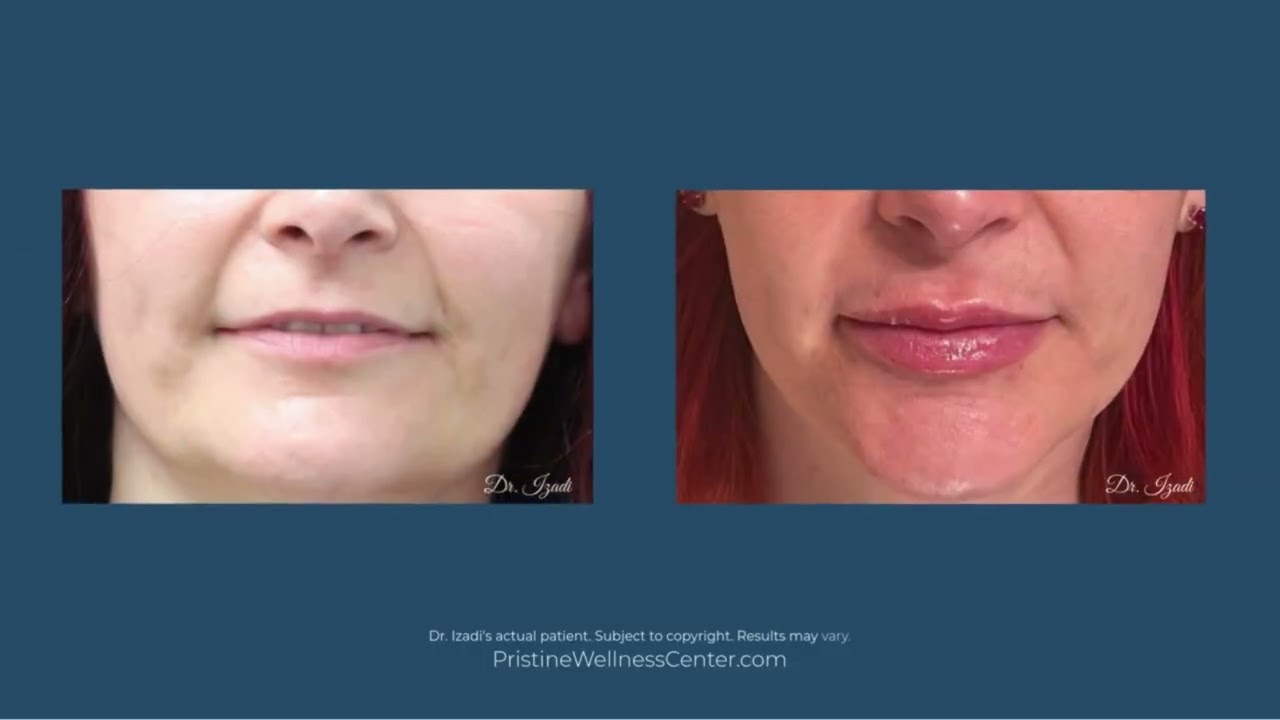 Actual patients' before and after pictures, Dr. Izadi