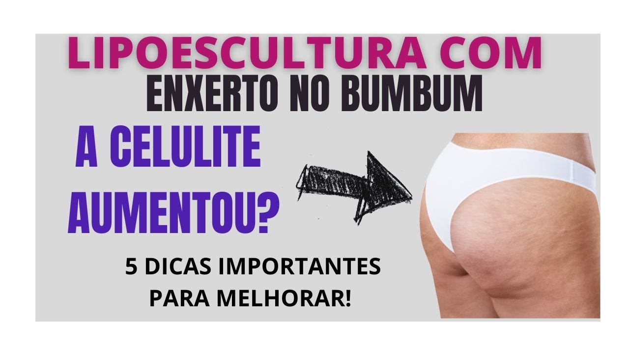 LIPO COM ENXERTO NO BUMBUM: A CELULITE AUMENTOU? O QUE FAZER PARA MELHORAR!