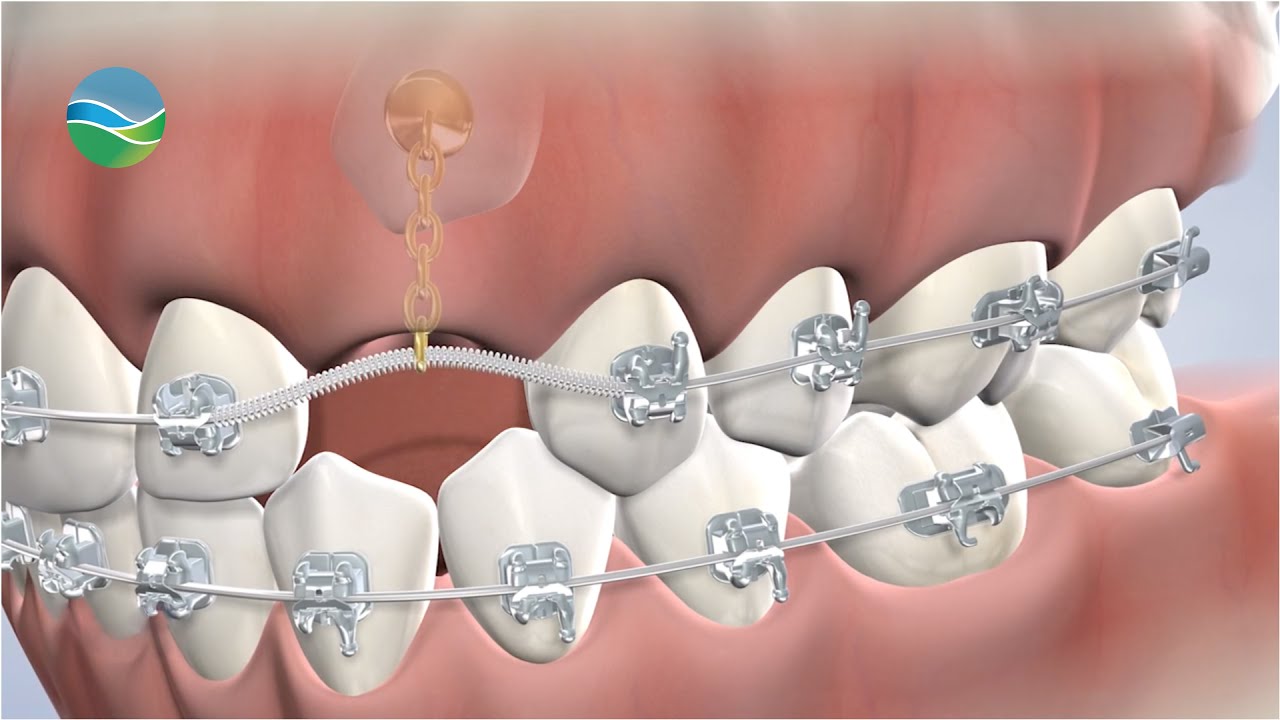 Expose and Bond at Southern Oral & Facial Surgery in Franklin, TN