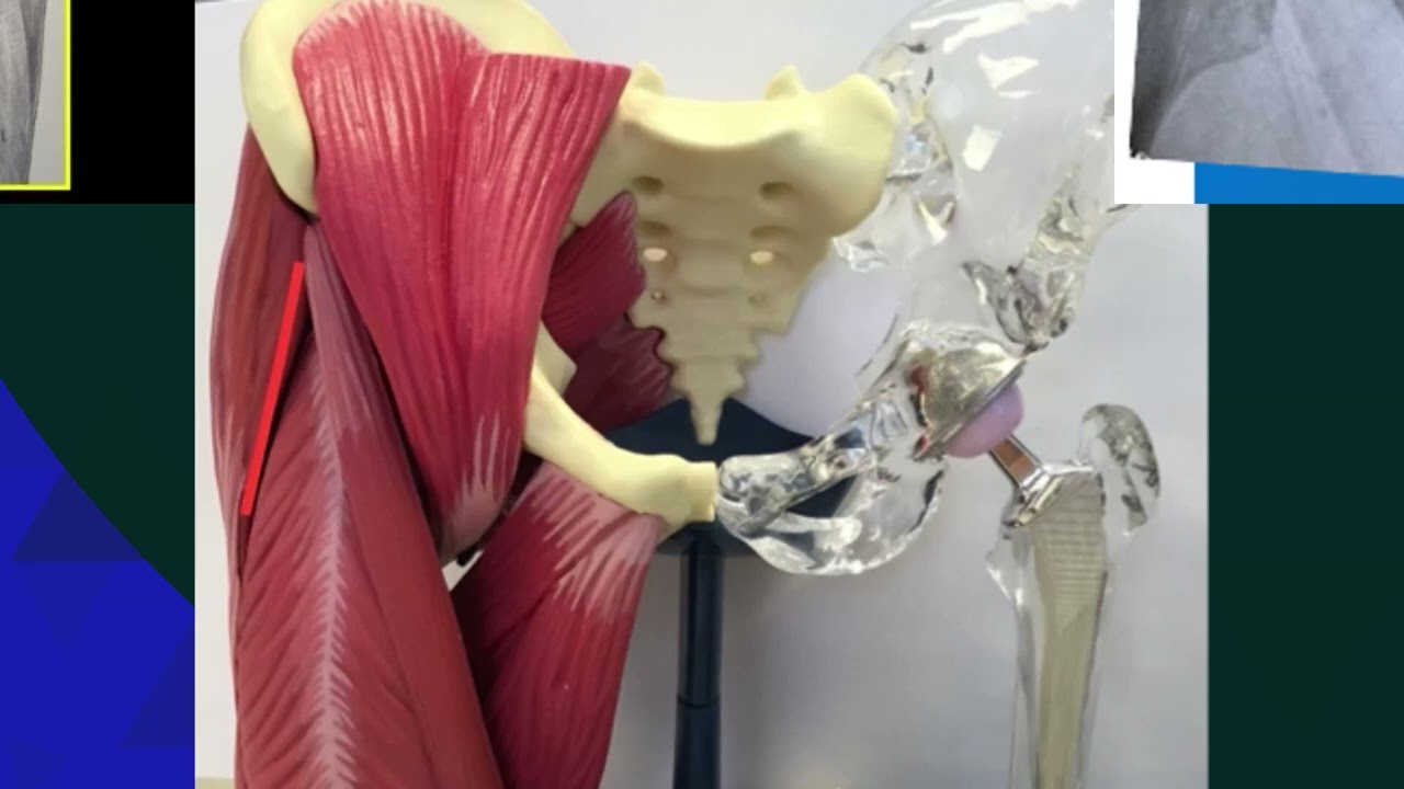 What is hip replacement?  Learn about arthritis, surgery, anterior approach, and implant materials