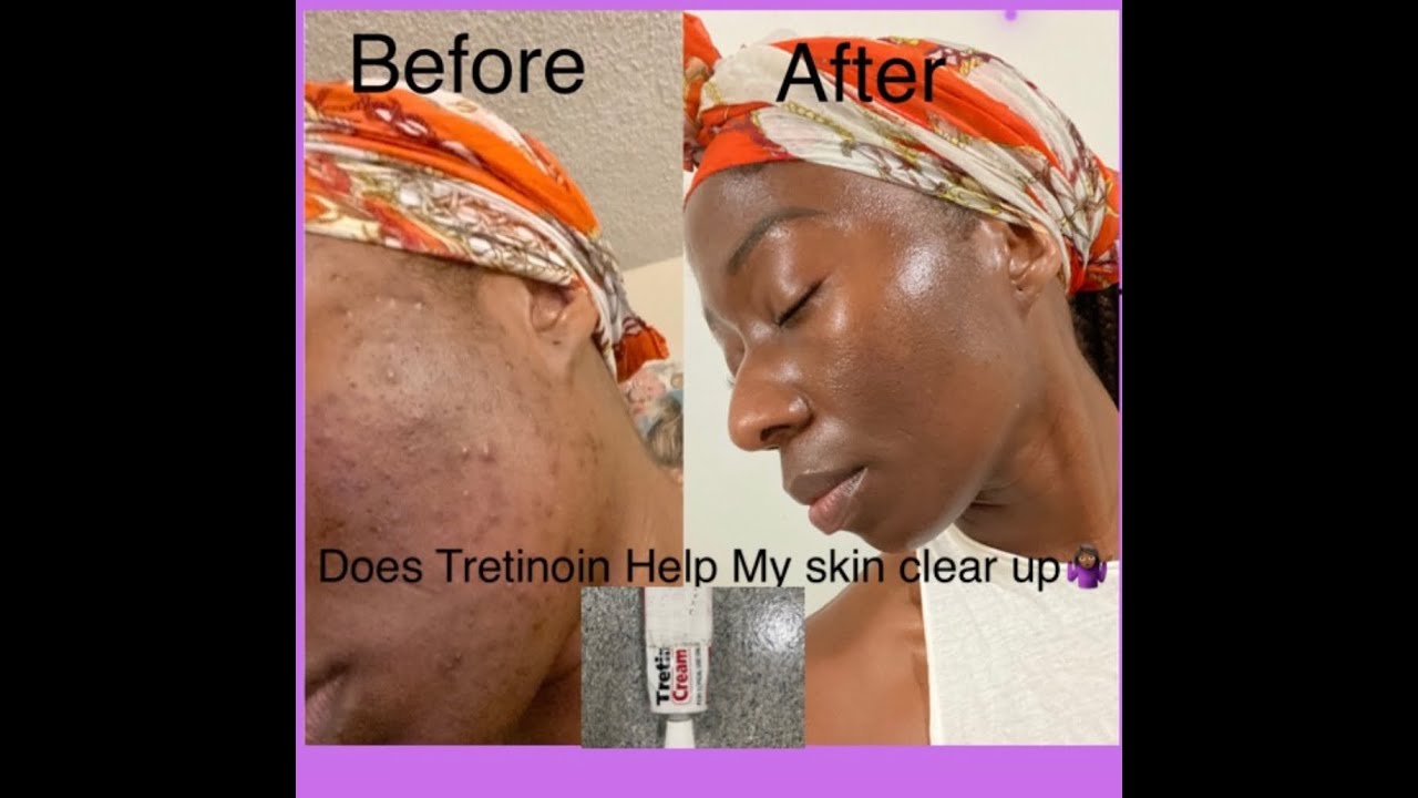 Does Tretinoin Works On Darker Skin Complexion