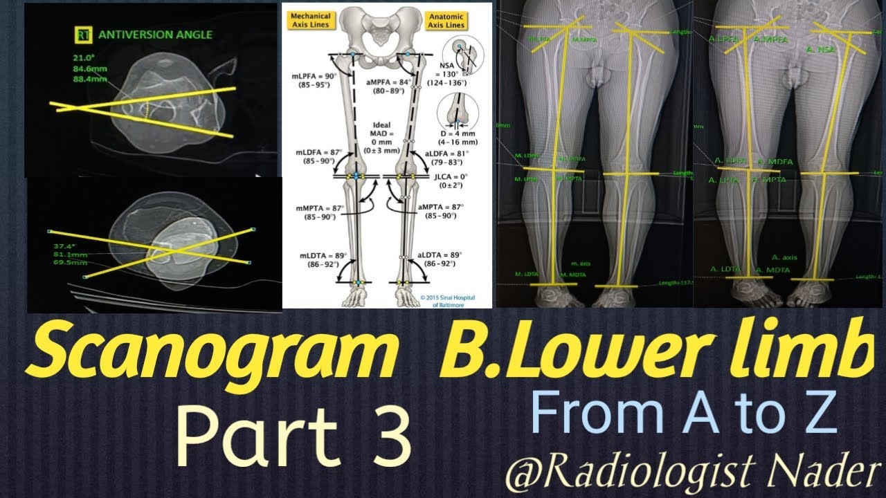 سكانوجرام.الجزء3(المحور التشريحي وزواياه)Scanogram B.lower limb. part 3(Anatomical Axis with Angles)