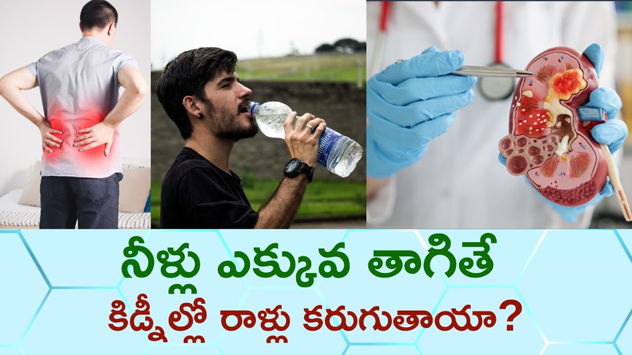 Will Drinking Too Much Water Dissolve Kidney Stones?
