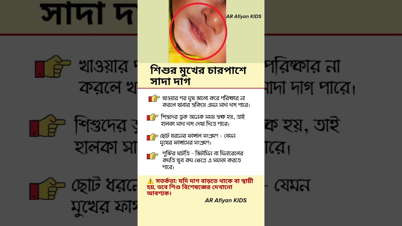 শিশুর মুখের চারপাশে সাদা দাগ #baby #babyhealth