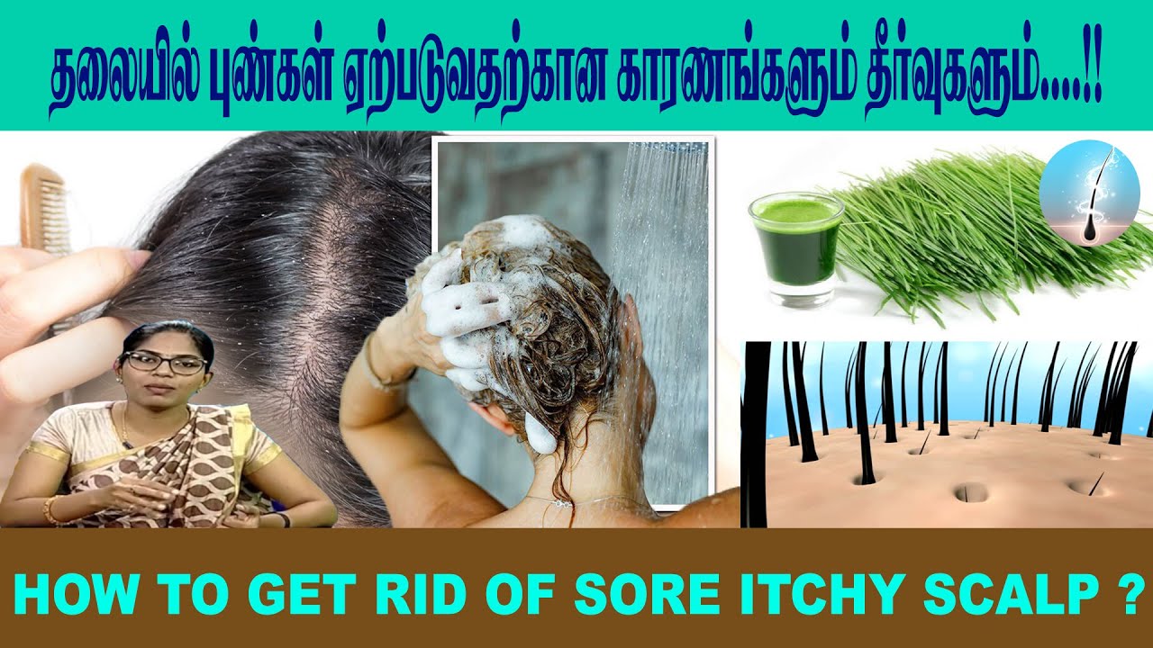 தலையில் புண்கள் ஏற்படுவதற்கான காரணங்களும் தீர்வுகளும்...!!  | How to get rid of sore itchy scalp?