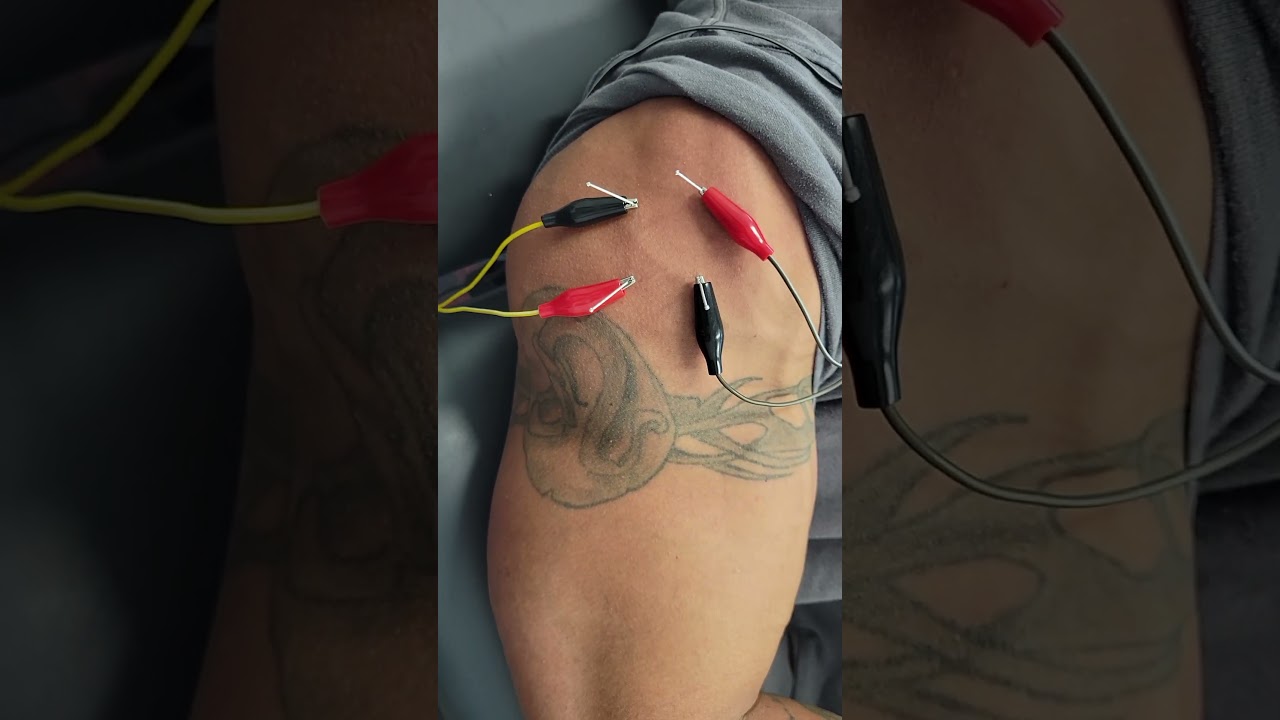 Deltoid dry needling to help decrease pain with lateral raises