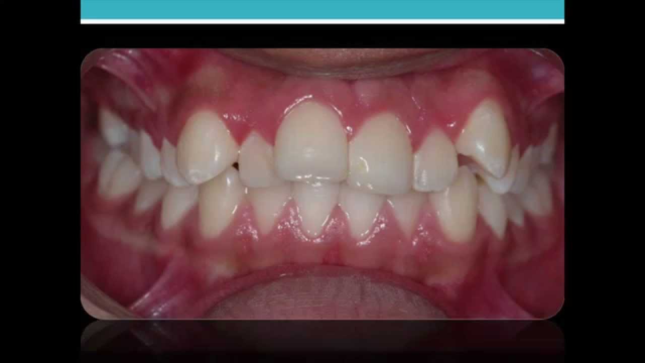 Caso #1. Sistema Biofuncional QR - 1001Tips en Ortodoncia
