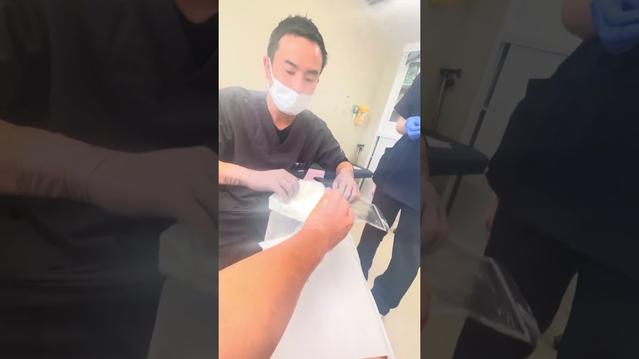骨折の抜釘（ばってい）ピン抜き