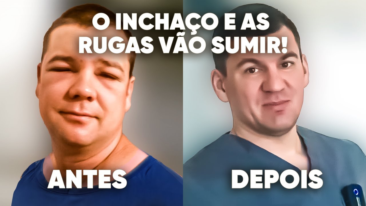 Ele eliminou de vez o inchaço no rosto e as rugas e ficou lindão!
