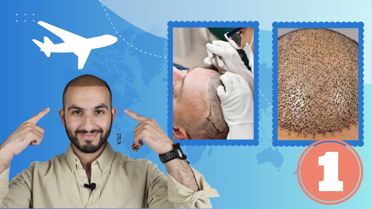 زراعة الشعر و اختيار العيادة (زراعة الشعر في تركيا)