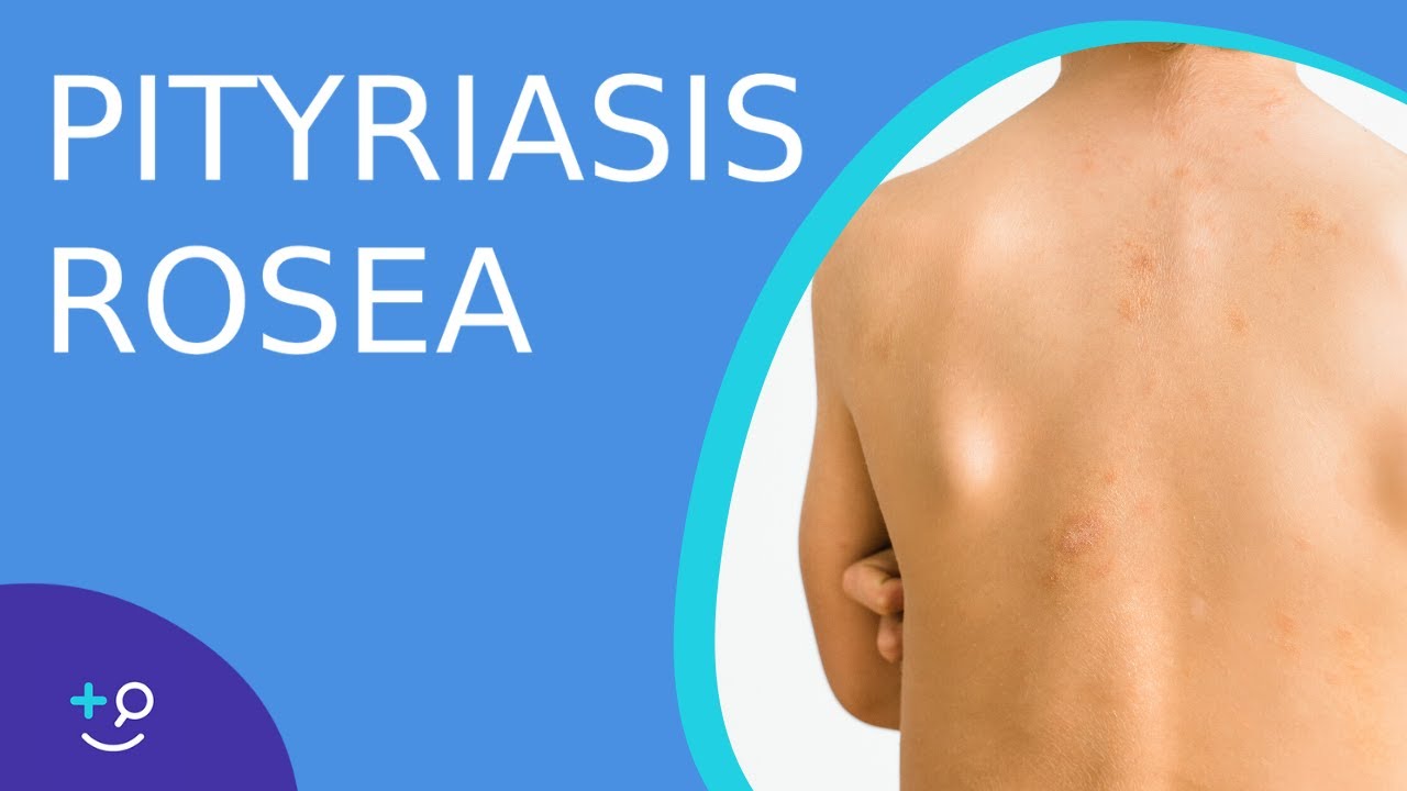 Pityriasis Rosea - Daily Do's of Dermatology