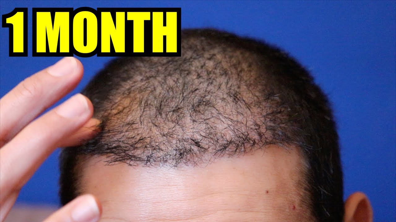 2nd FUE Hair Transplant at 1 Month - HMR Tijuana