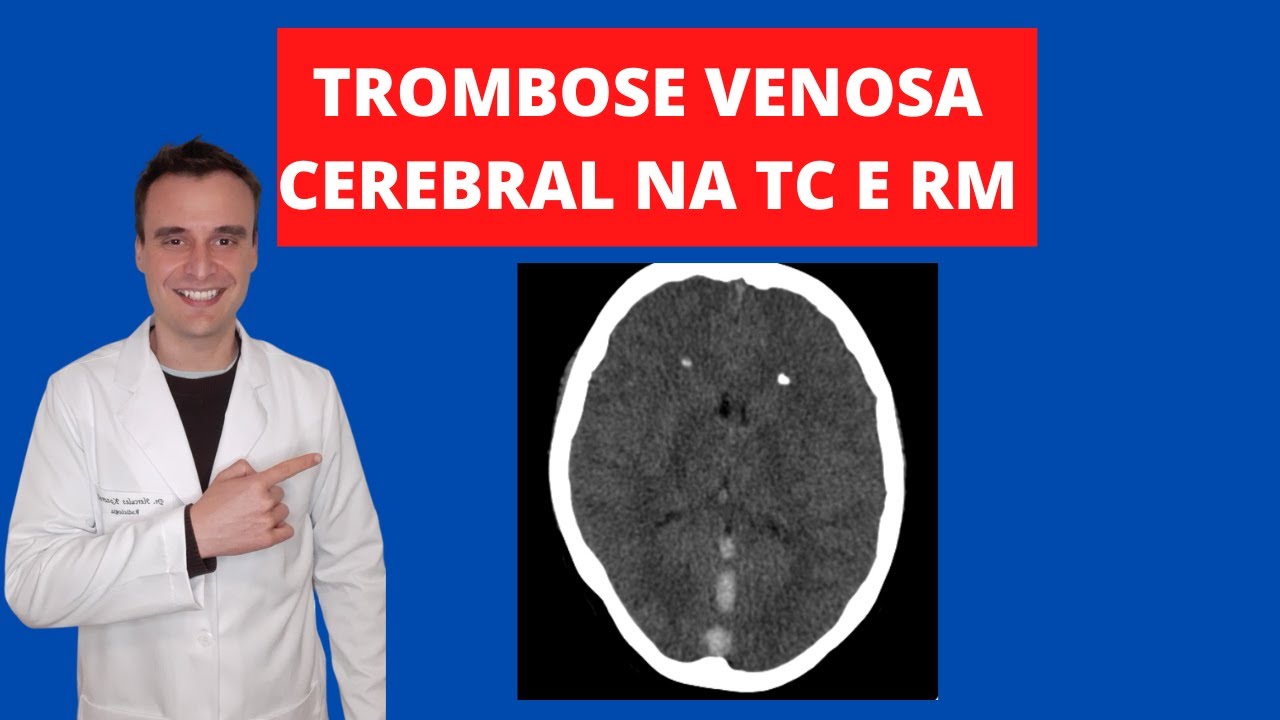 Trombose venosa cerebral na tomografia e ressonância magnética