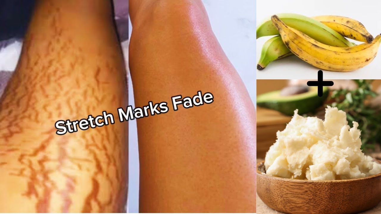 DIY Stretch Mark Cream Using Plantain Skin & Shea Butter | Natural Skincare Remedy