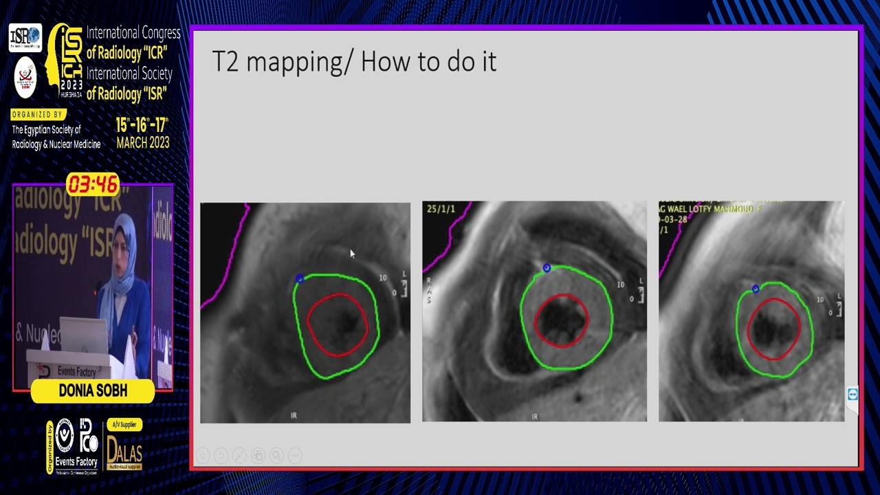 T1 & T2 Mapping in Cardiac MRI: Clinical Applications
