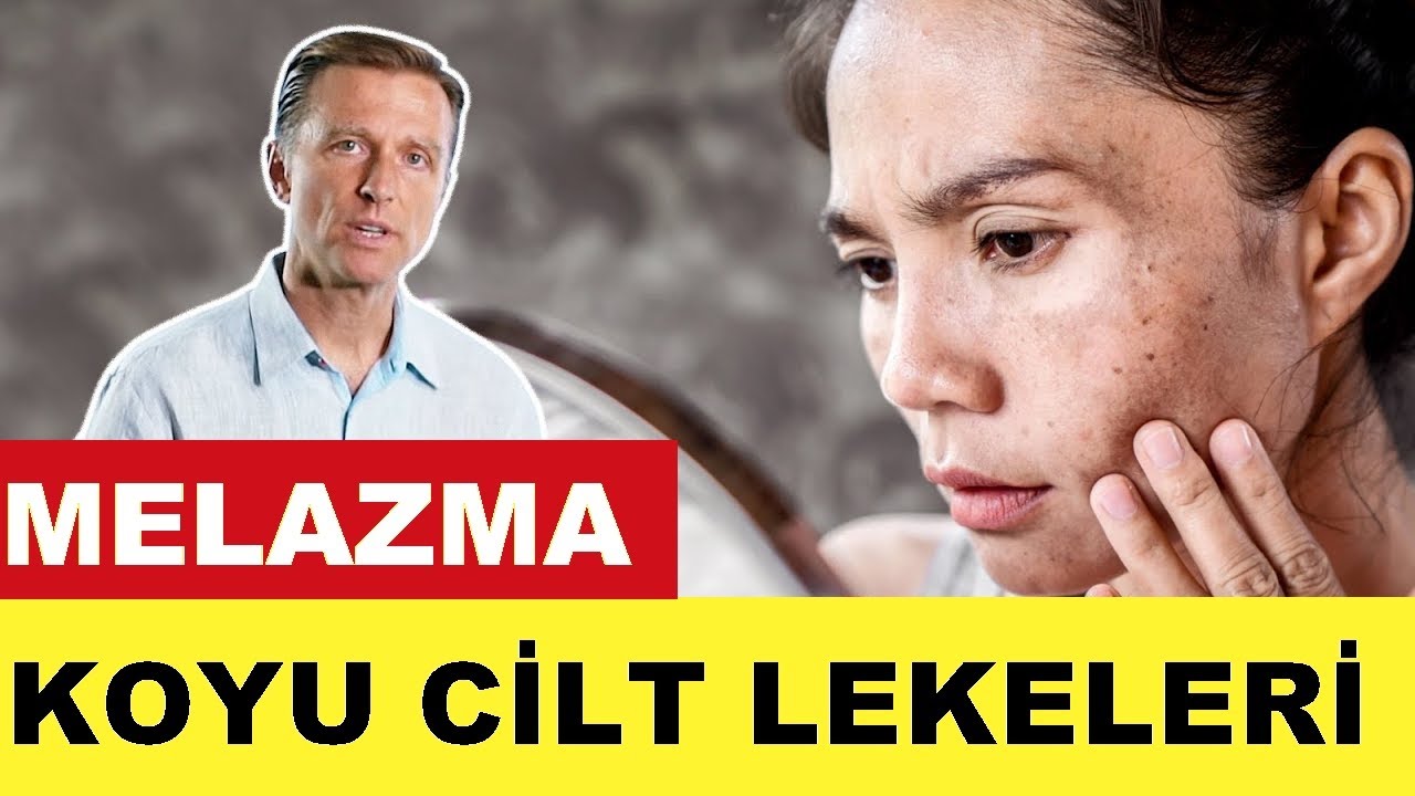 Melazma | koyu cilt lekeleri  3 neden ve ipuçları