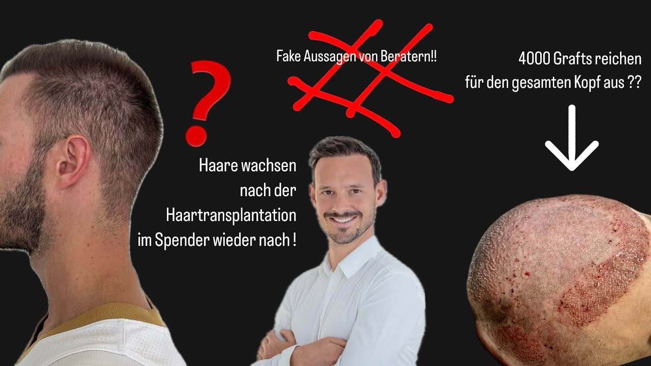 Haartransplantationsberater lügen mit diesen Aussagen !