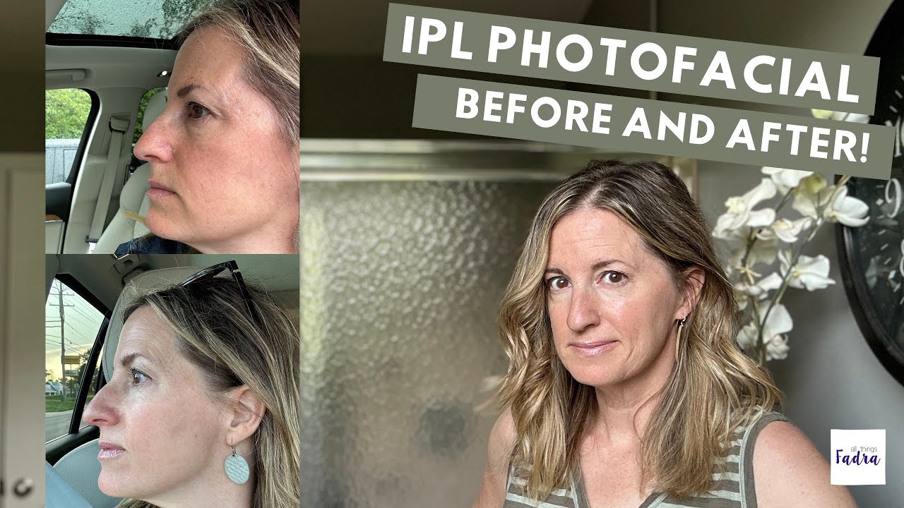 Фототерапия IPL до и после — стоит ли она того?