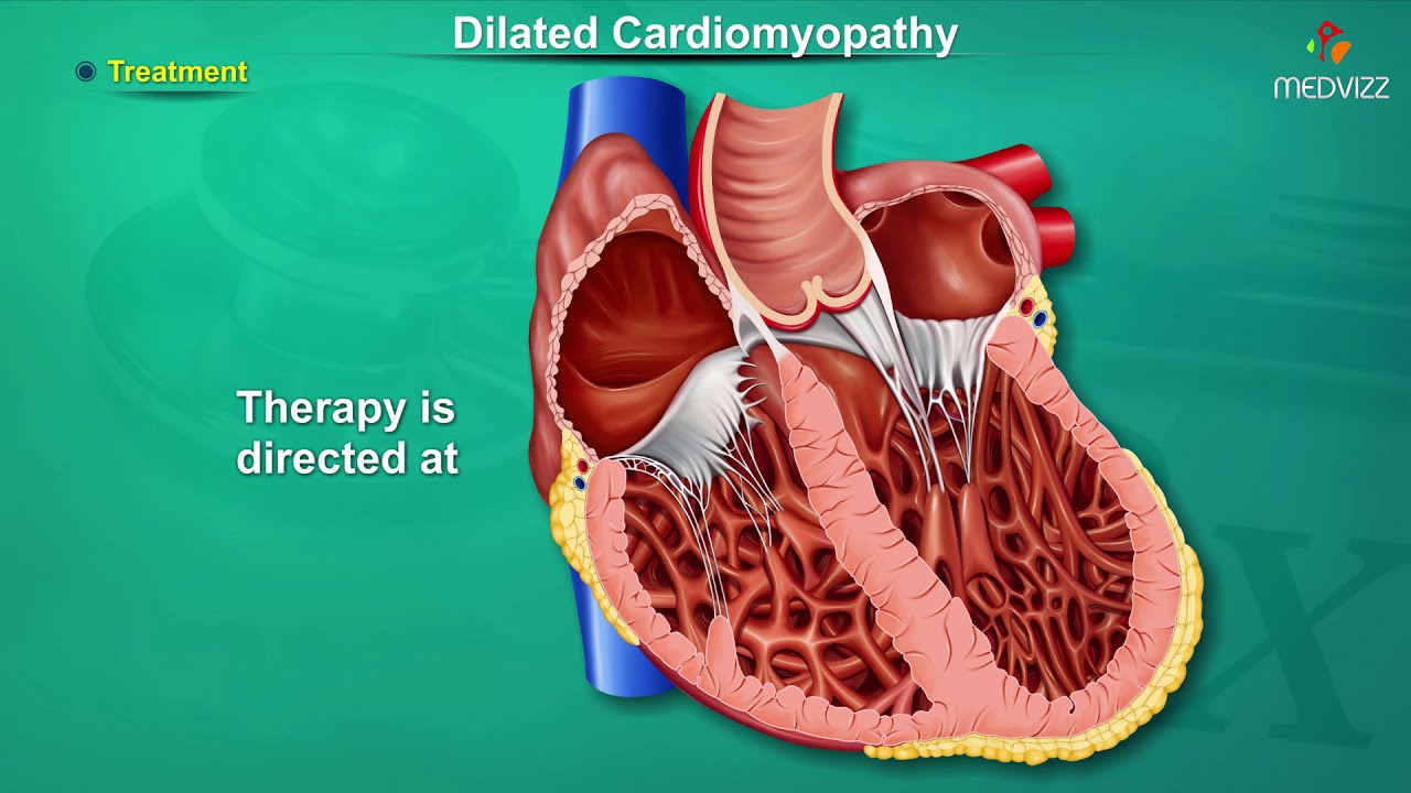 Dilated cardiomyopathy ( DCM ) : Causes, Signs and Symptoms, Pathogenesis, Diagnosis, and Treatment