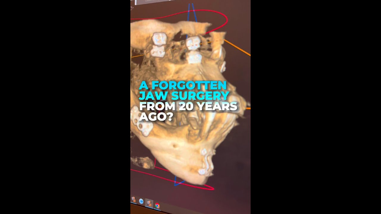 A Forgotten Jaw Surgery from 20 Years Ago?