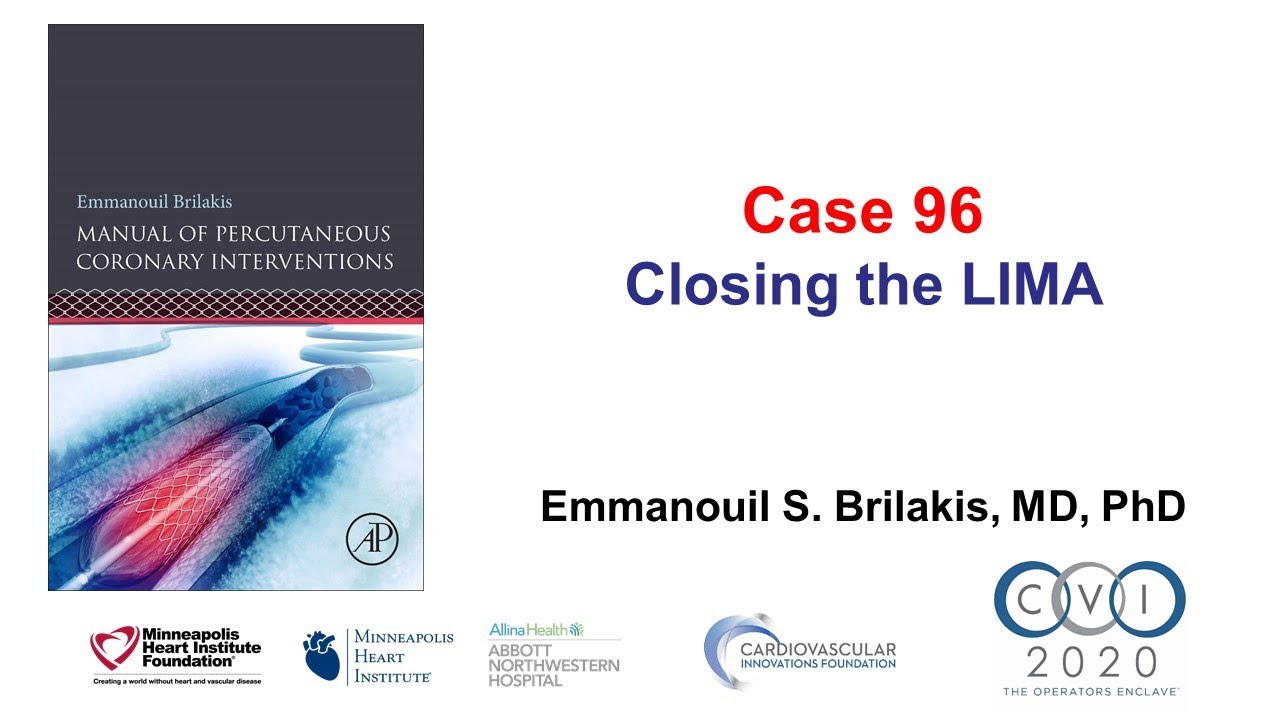 Case 96: PCI Manual - Closing the LIMA
