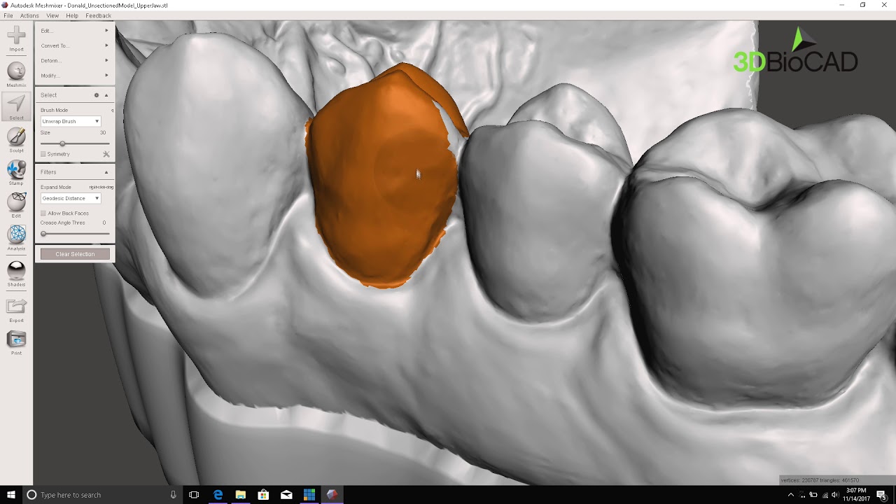 3DBioCAD - MeshMixer: How to remove a tooth from a digital model.