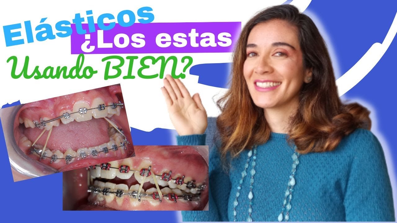 🔎Esto es lo que pasa cuando NO USAS BIEN LOS ELÁSTICOS de ortodoncia 😱