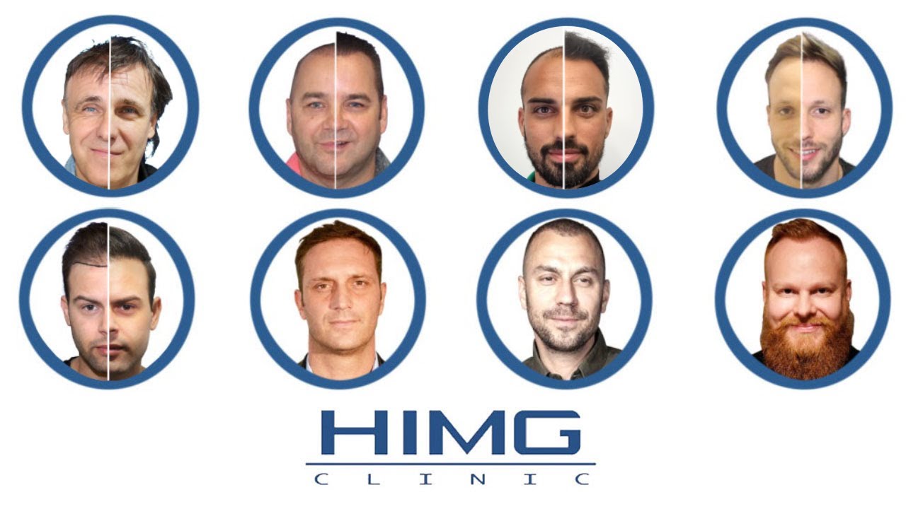 Hírességek Hajbeültetés előtt és után - HIMG Hajbeültetési Klinika⚡