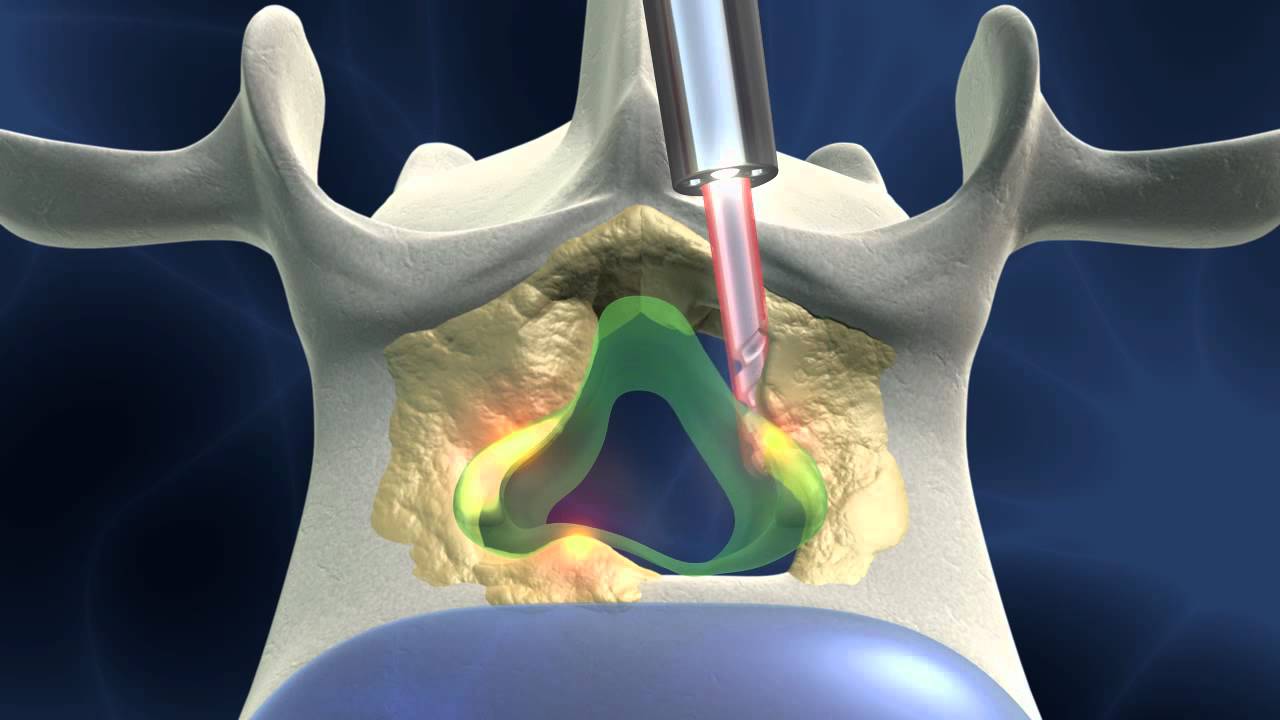 Full-endoscopic spinal surgery for spinal stenosis; dorsal approach