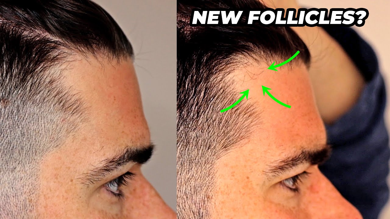 I Put ROSEMARY OIL on My Head For 8 Months
