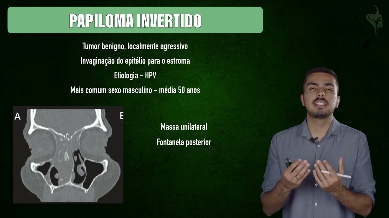 ORL QUEST - Rinologia: Papiloma Invertido