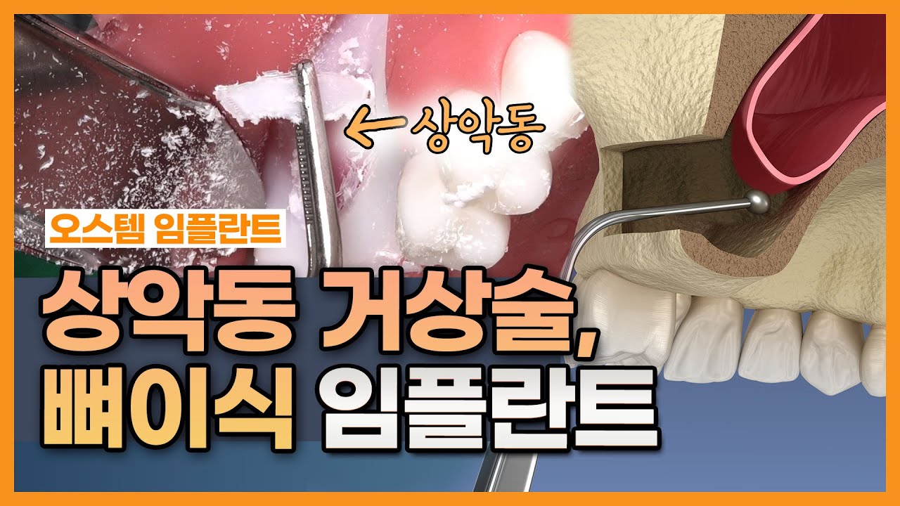 상악동거상술, 뼈이식 임플란트 과정 직접 보여드리겠습니다.