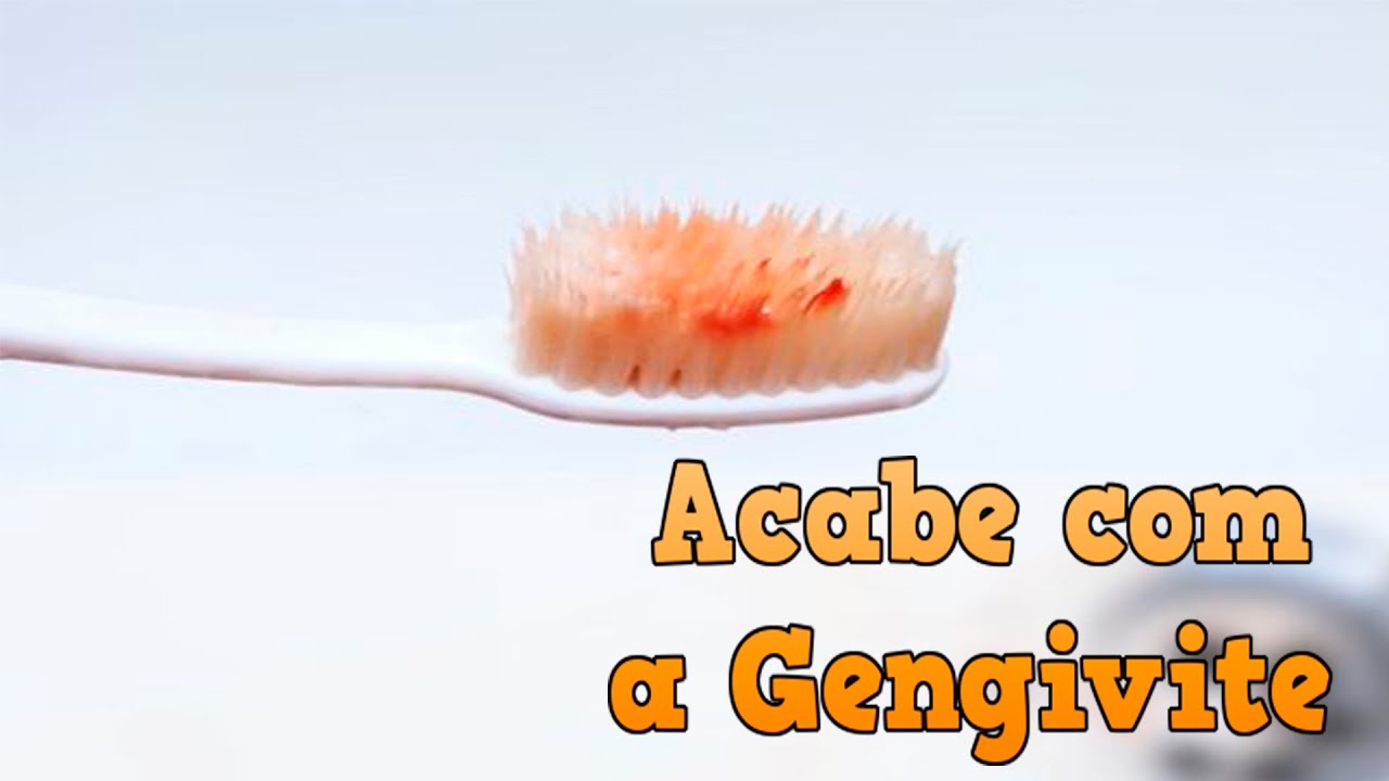 Gengivite e sangramento na gengiva. Saiba como acabar com ela. Gengiva sensível nunca mais.