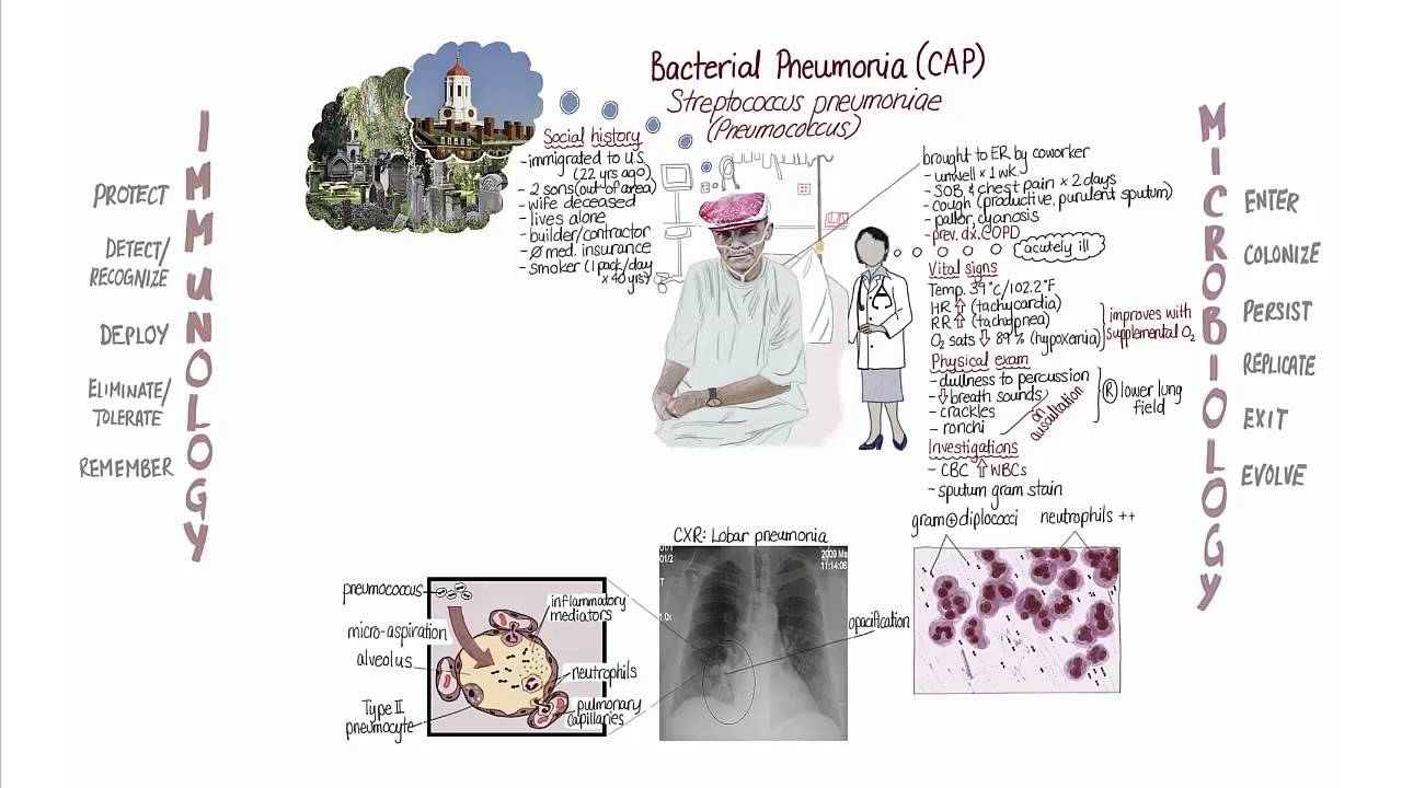 Pneumonia Springboard