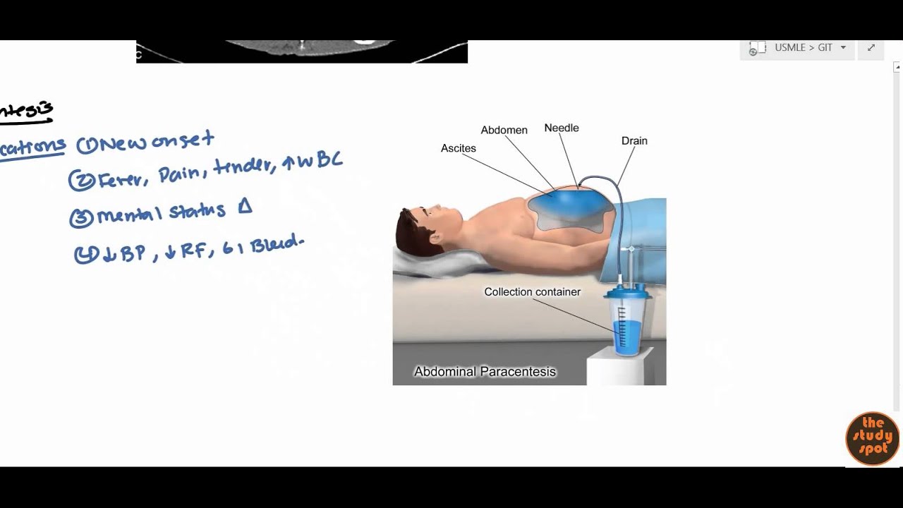 Асцит для USMLE Step 2