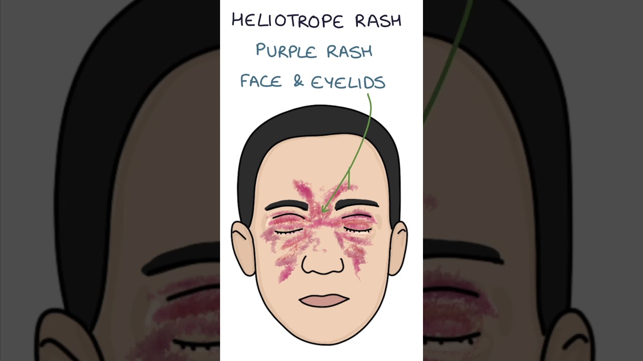 Dermatomyositis Skin Changes #dermatology #medicine #rheumatology