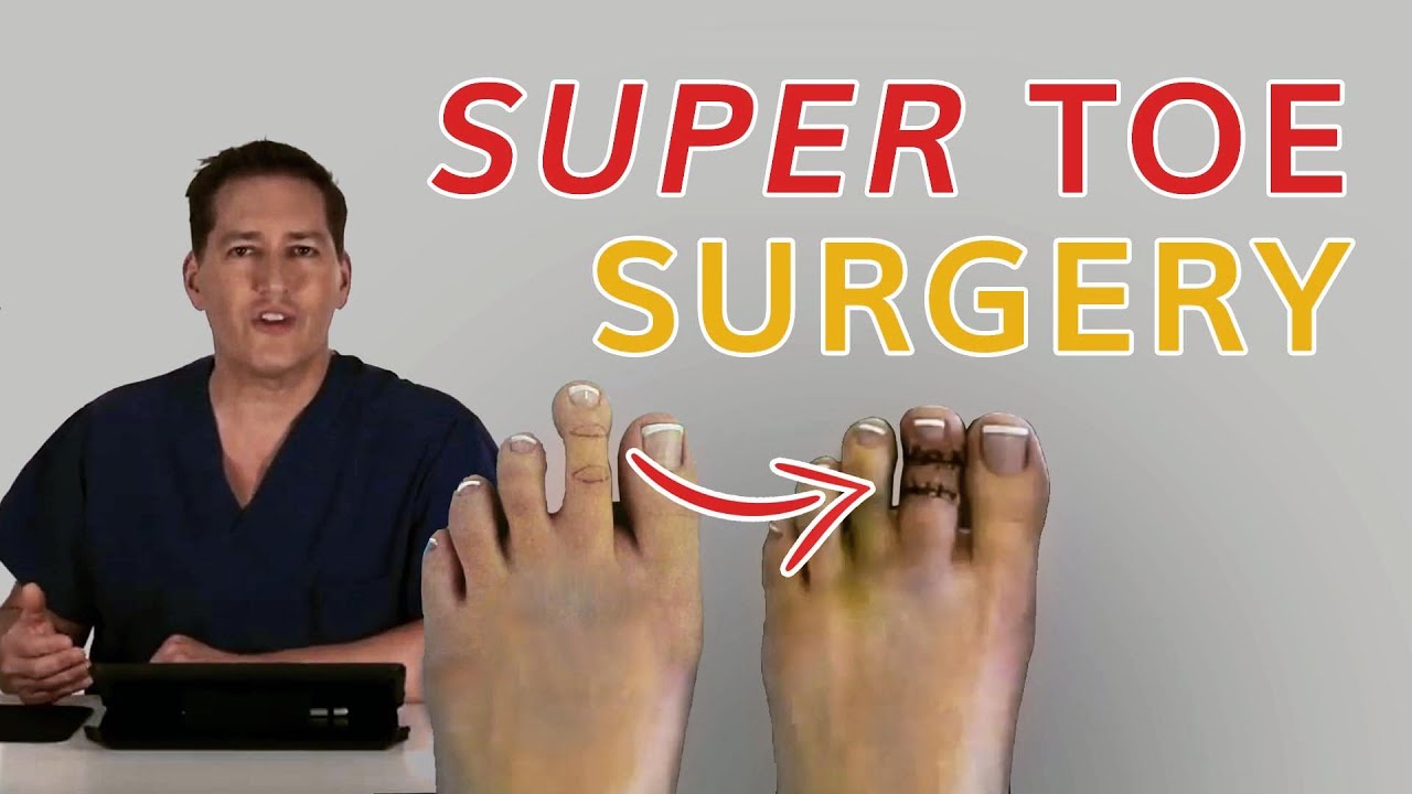 Super Toe Surgery  - Dr. Michael Horwitz - Feet For Life Channel