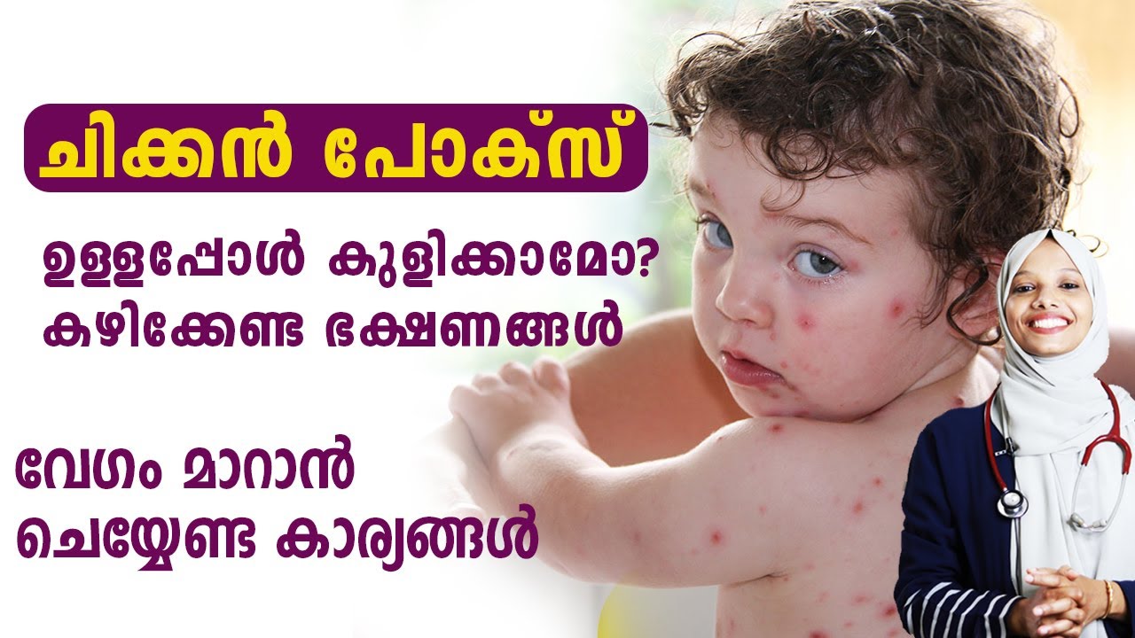 ചിക്കൻ പോക്സ് വേഗം മാറാൻ  |  chickenpox malayalam | Dr couple