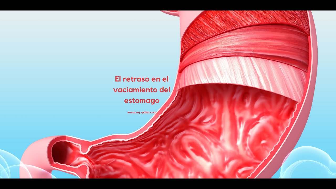 Retraso en el vaciamiento gastrico o Gastroparesis