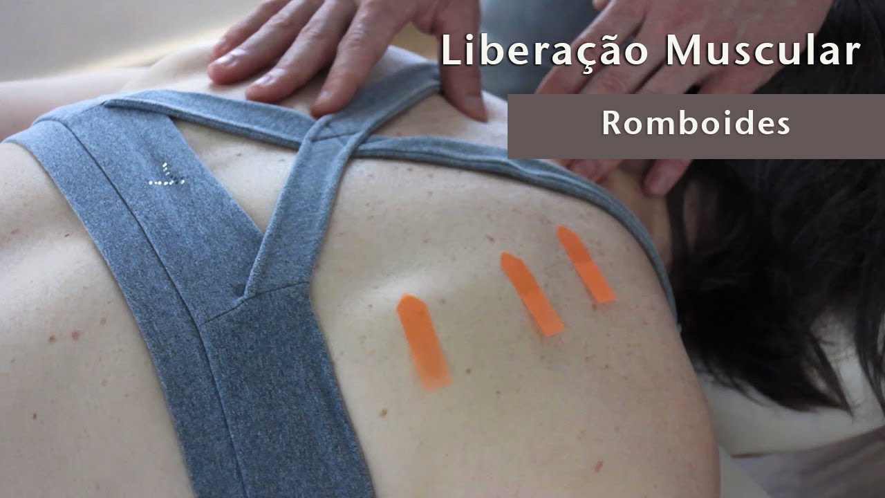 Pontos-gatilho e liberação manual: Romboides