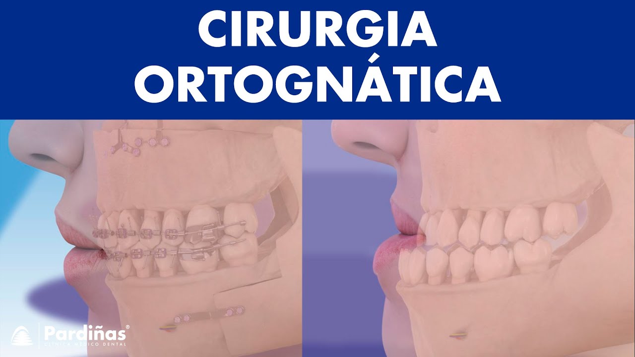 Cirurgia ORTOGNÁTICA - Cirurgia de mandibula para correção de posição ©