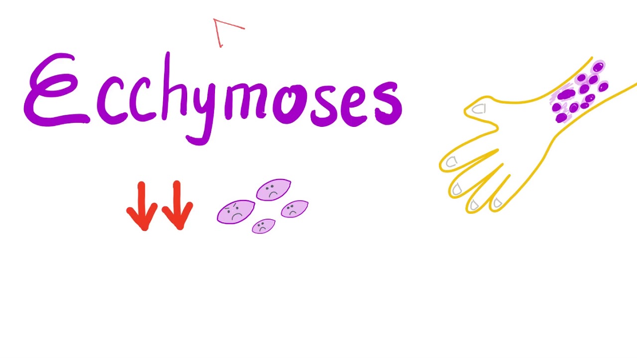 Ecchymoses | Low Platelet Count