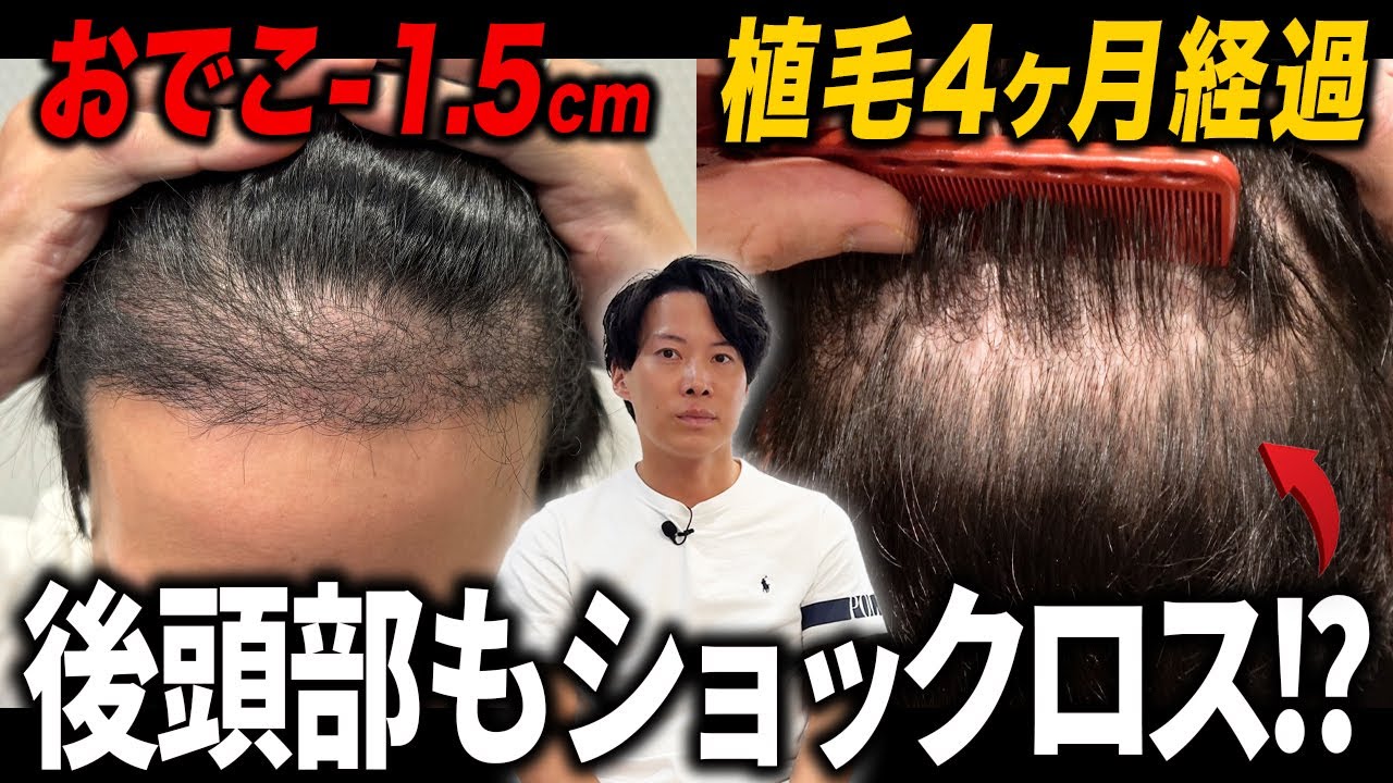 【異例の事態】植毛して4ヶ月で後頭部の毛が薄くなりました...。