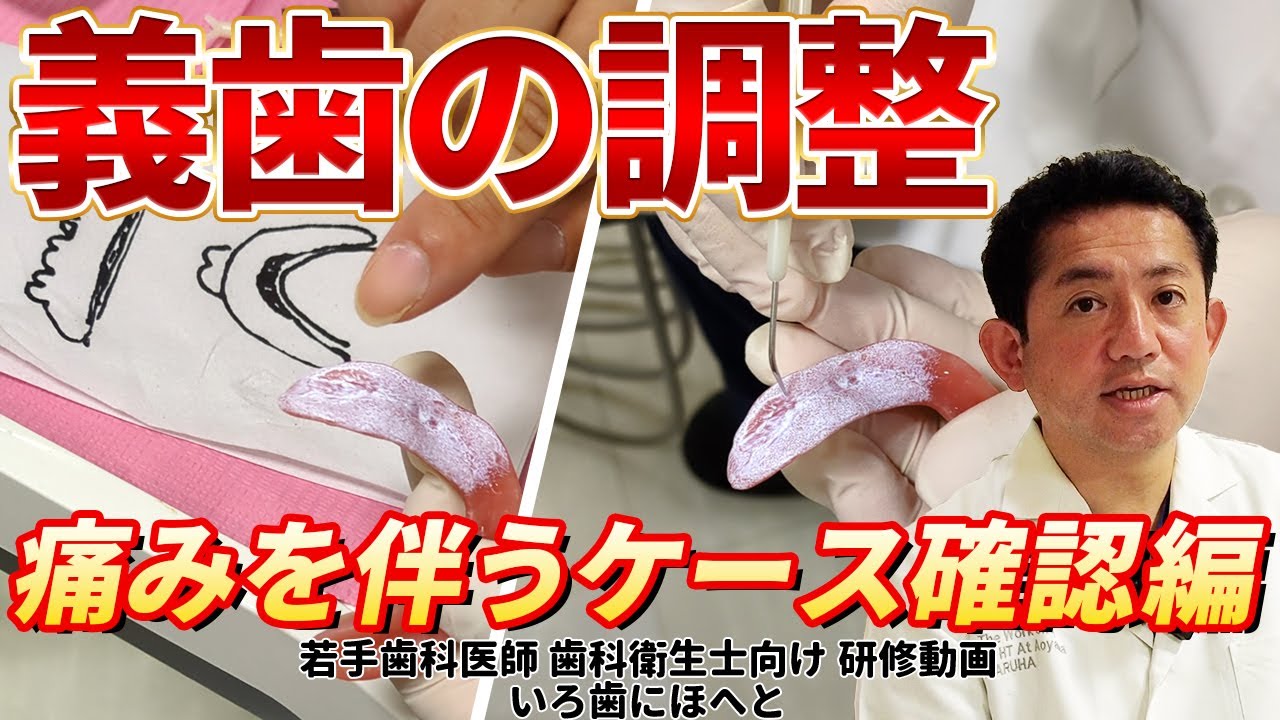義歯の調整#2【痛みを伴うケースの確認編】