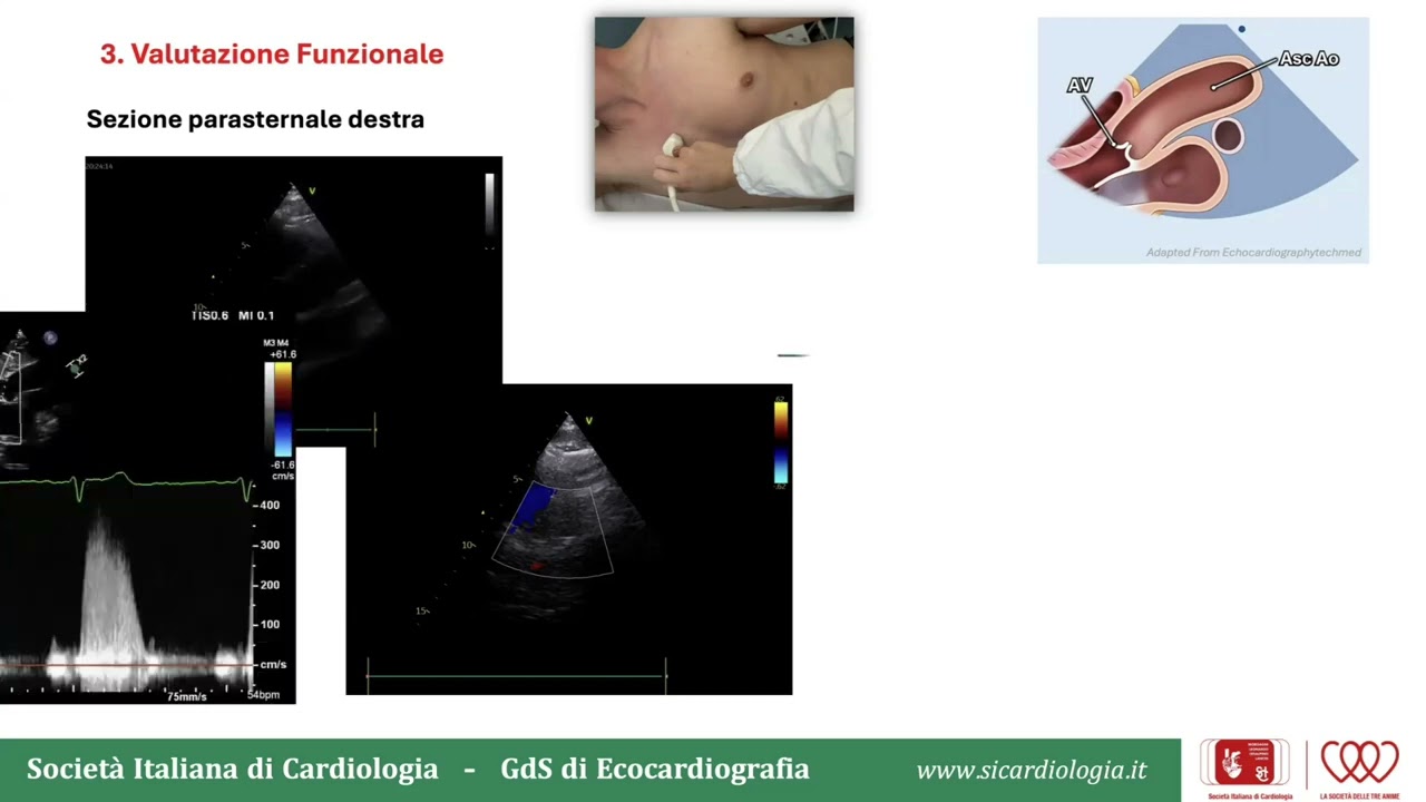 Valutazione Ecocardiografica transtoracica della stenosi valvolare aortica