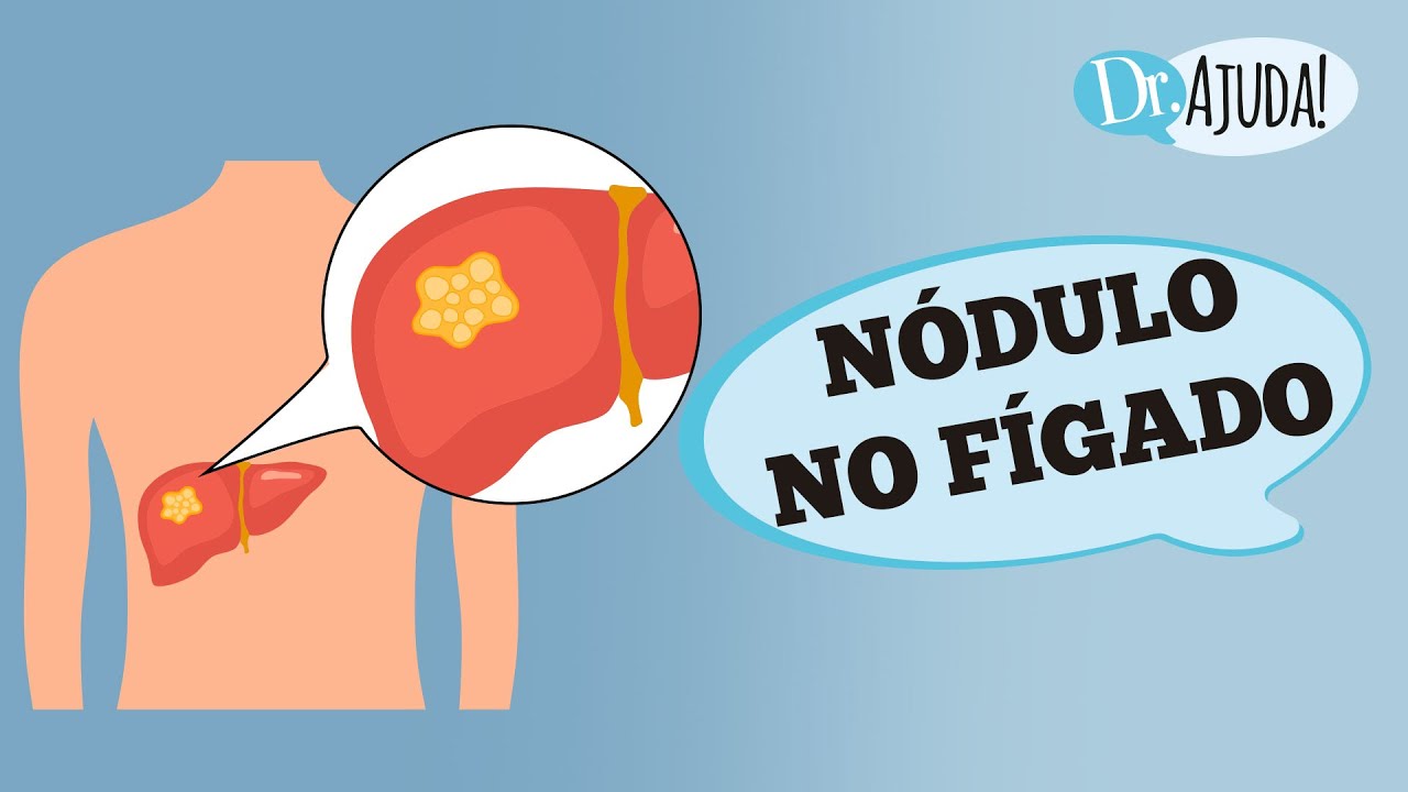 TUMOR BENIGNO, MALIGNO DO F&Iacute;GADO OU MET&Aacute;STASE: COMO DIFERENCIAR?