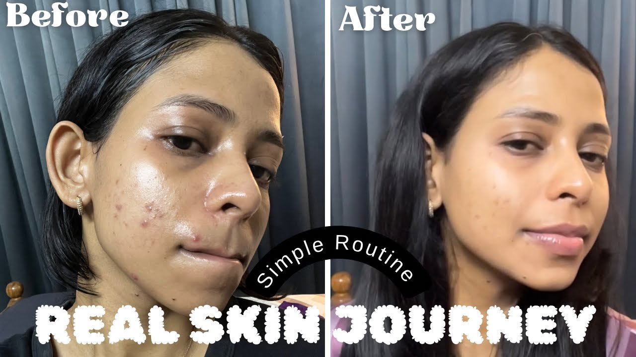 I Stopped Overdoing Skincare & My Acne Healed