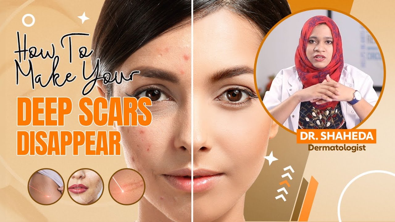 Deep Scar Removal Methods | Steps To Get Rid Of A Deep Scar by Dr. Shahida | Kolors Healthcare
