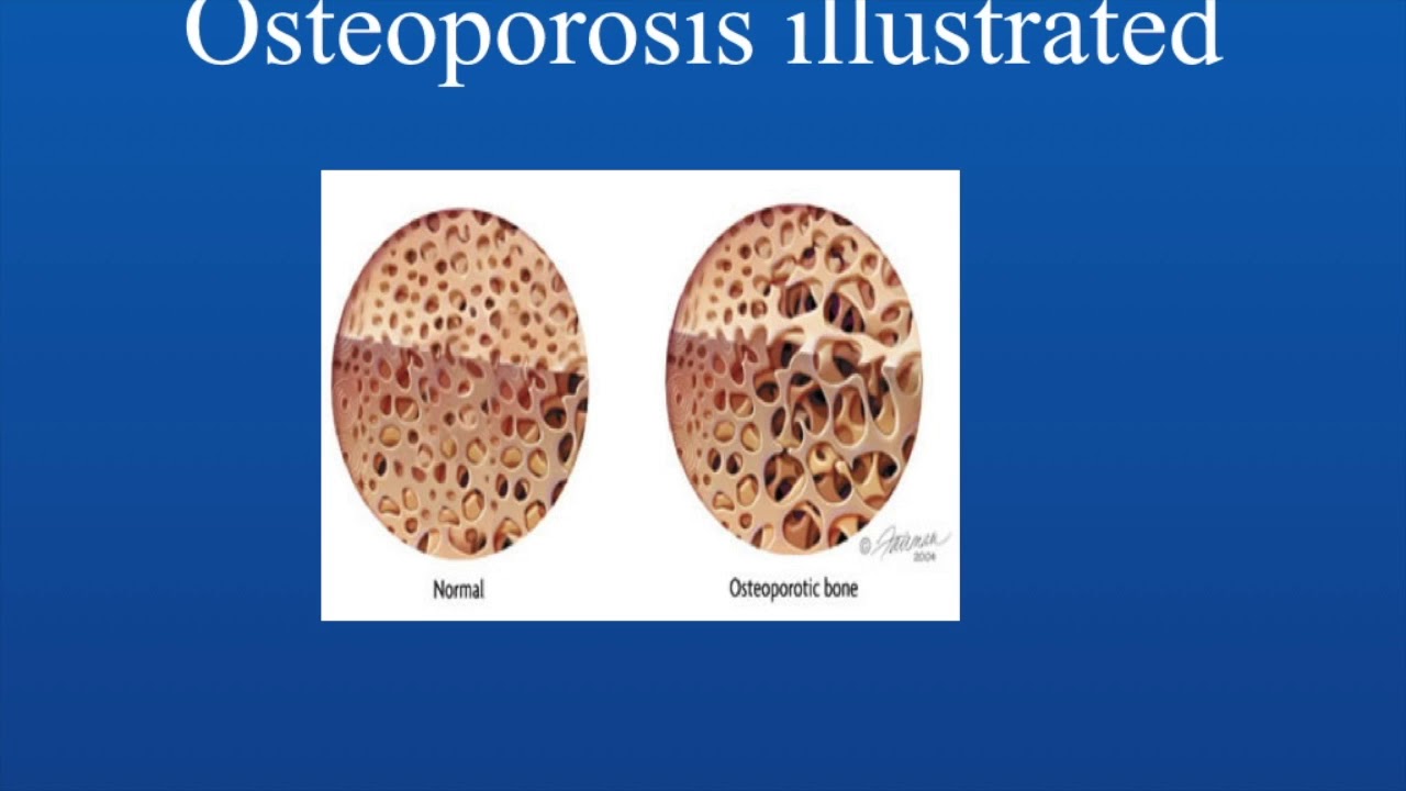 Anesthetic Concerns in the Patient with Rheumatological Diseases - AnesthesiaExam Video Series