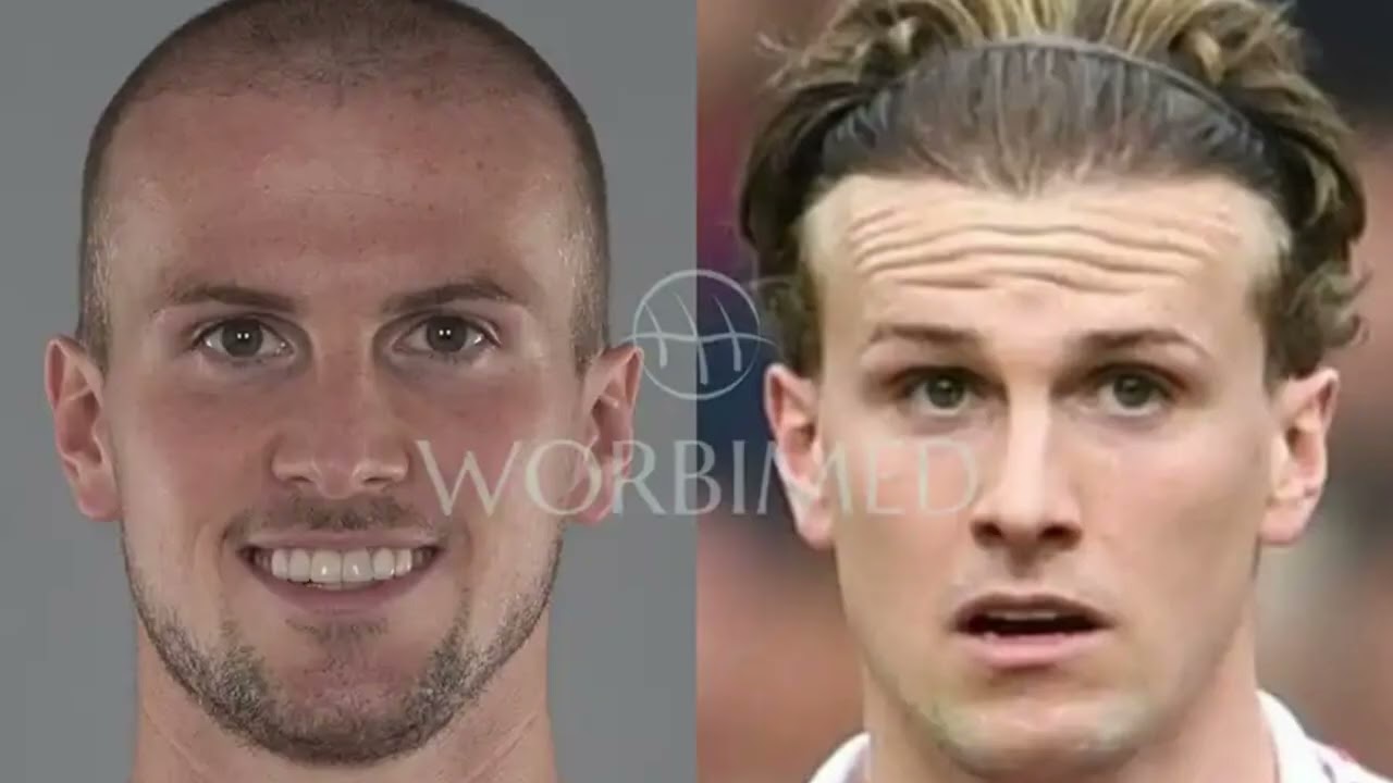 What Actually Makes a Hair Transplant Look Natural? Density, irregularity, Design?